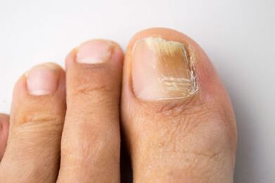Az élesztő mikroorganizmusok által okozott mycosis