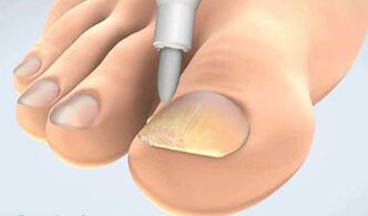 onychomycosis kaparó gyűjtemény